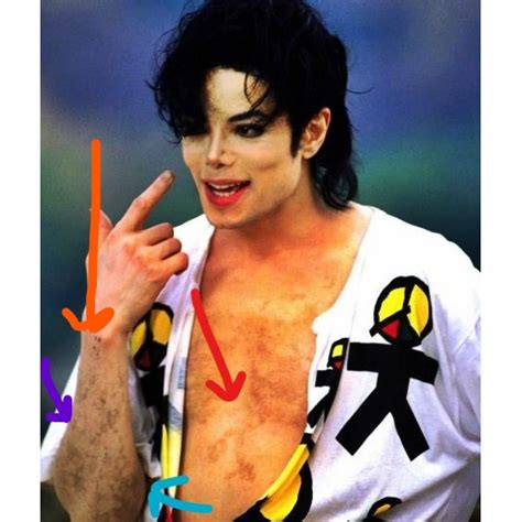 michael jackson vitiligo hastalığı